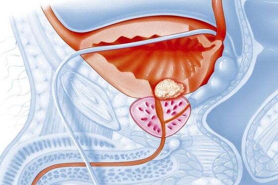 Inflammatory process in the prostate.