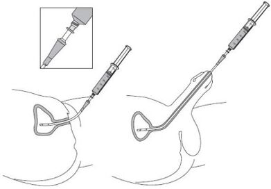 Instillation of a pharmacological solution in urethra