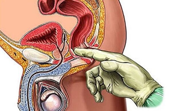 Prostate massage as a way to treat prostatitis.