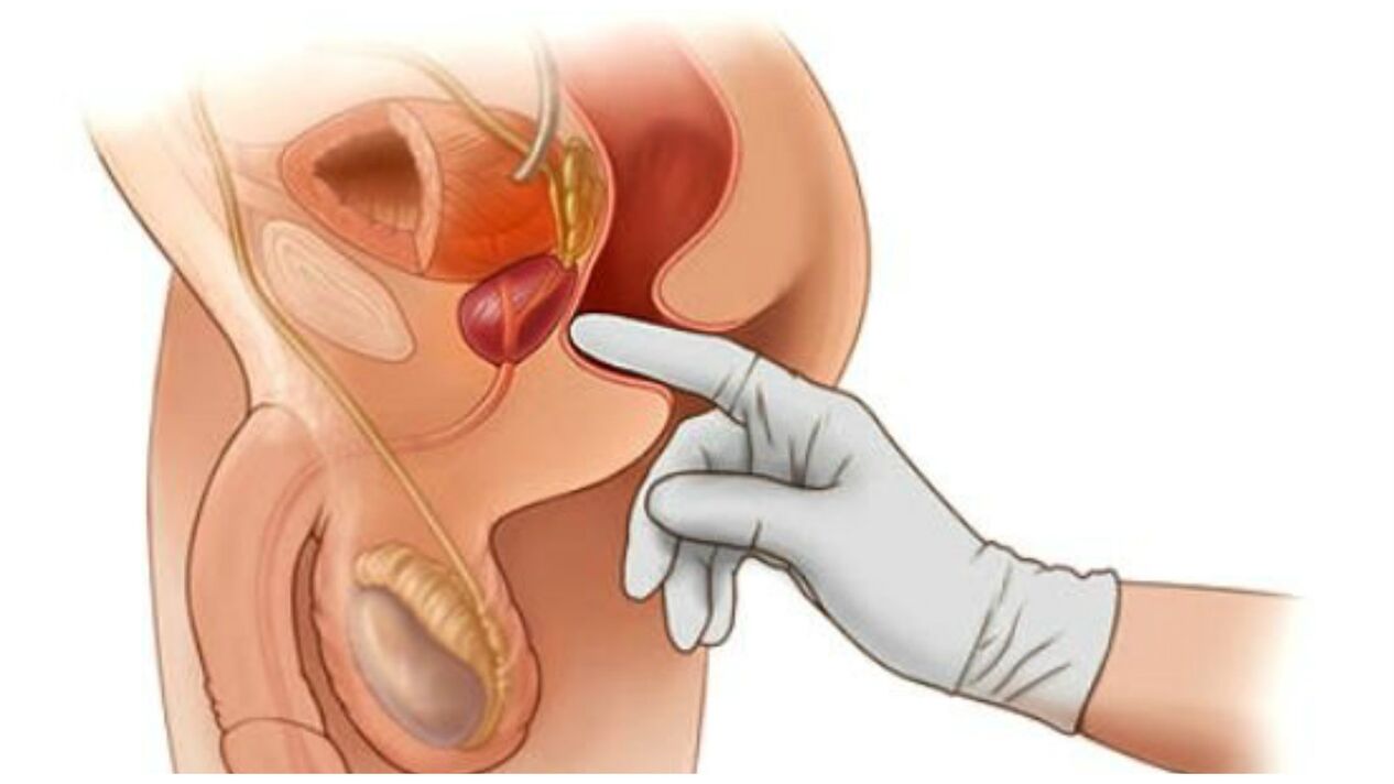 Prostate massage for chronic prostatitis.