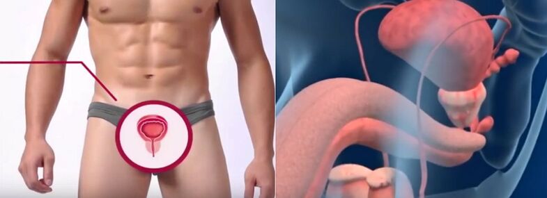 Prostatitis in men, recognizable by certain signs.