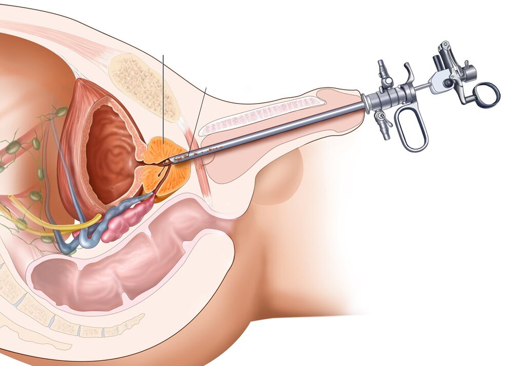 Transurethral resection of the prostate allows you to remove the affected parts of the organ