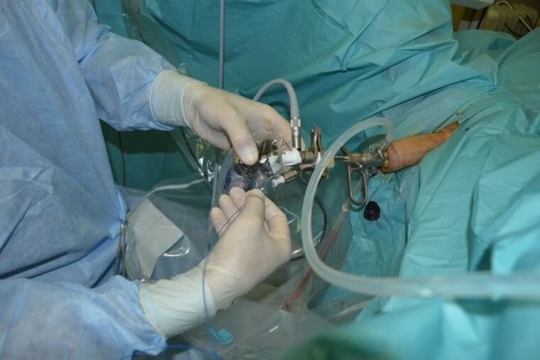 Transurethral resection of the prostate to remove part of the organ in chronic prostatitis